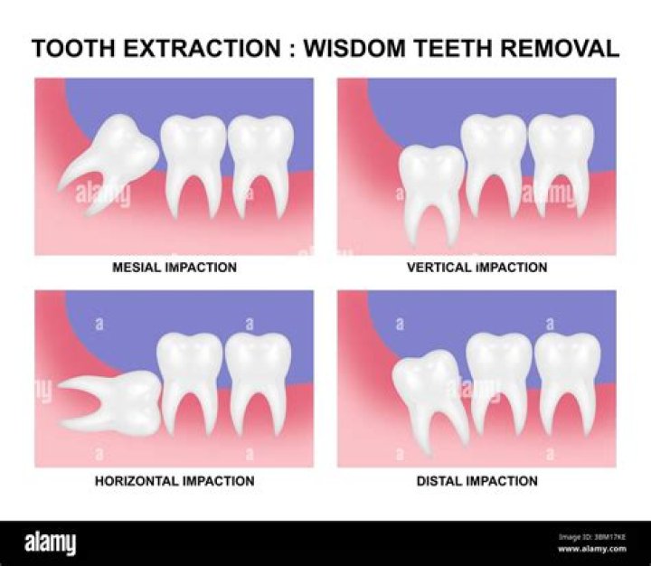 Are earaches common after wisdom teeth removal?