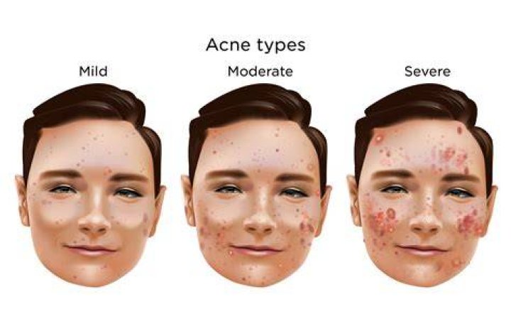Can ecstasy give you acne?