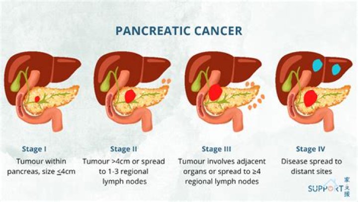 Can pancreatic cancer spread to ovaries?