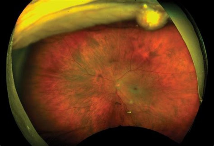 Can you recover from an eye stroke?