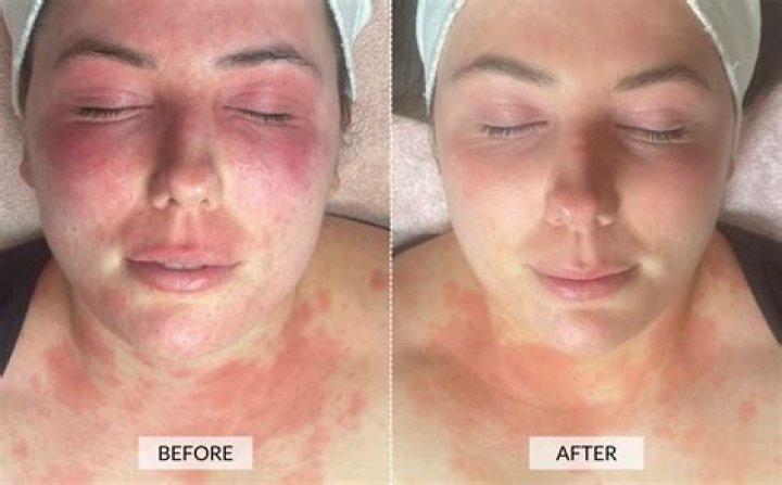 Does light therapy really work?