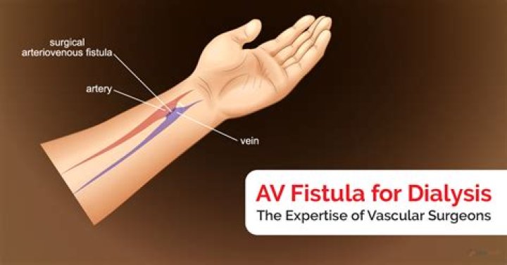 How AV fistula is created?