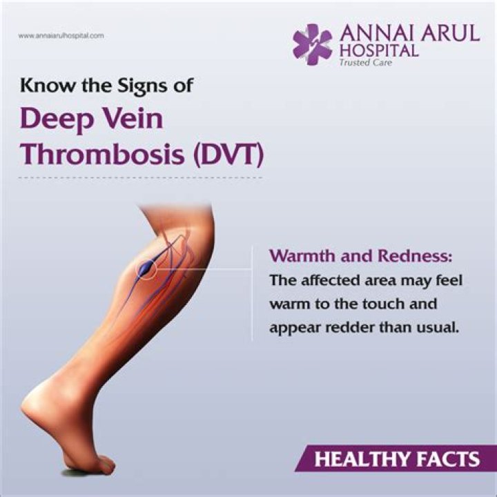 How do I know if I have DVT in my calf?