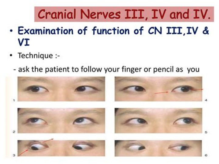 How do you assess CN III?
