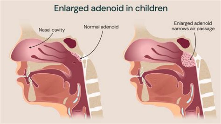 How do you get rid of bad breath after adenoid surgery?