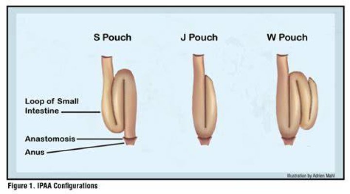 How long does IPAA surgery take?