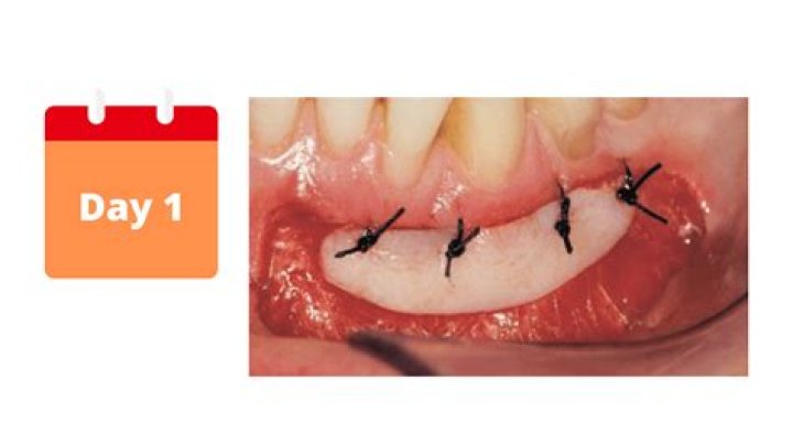 How long does it take for a gum to heal after apicoectomy?