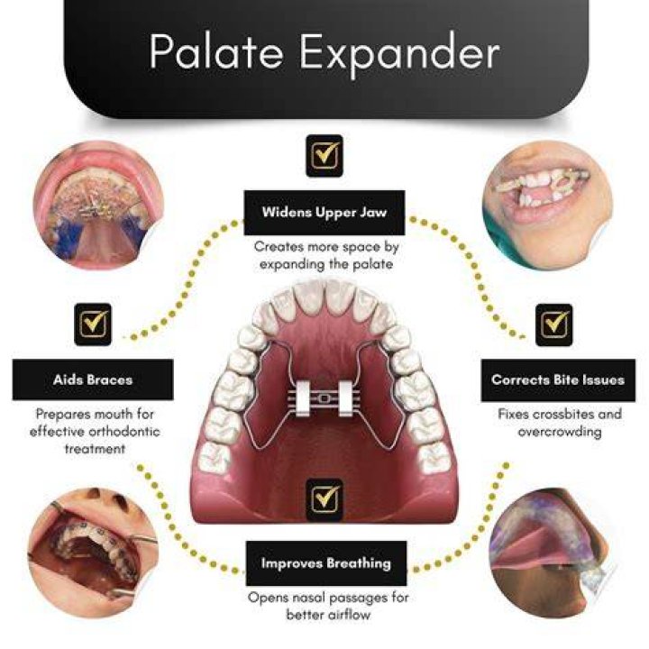 How long does it take for an expander to stop hurting?