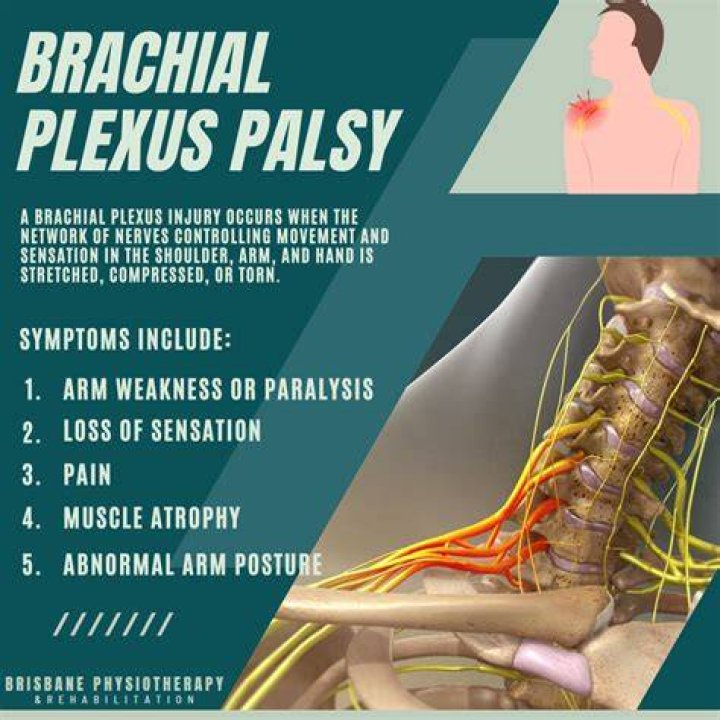 How long is recovery from brachial plexus surgery?