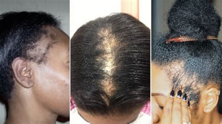 Is hair loss from diabetes permanent?