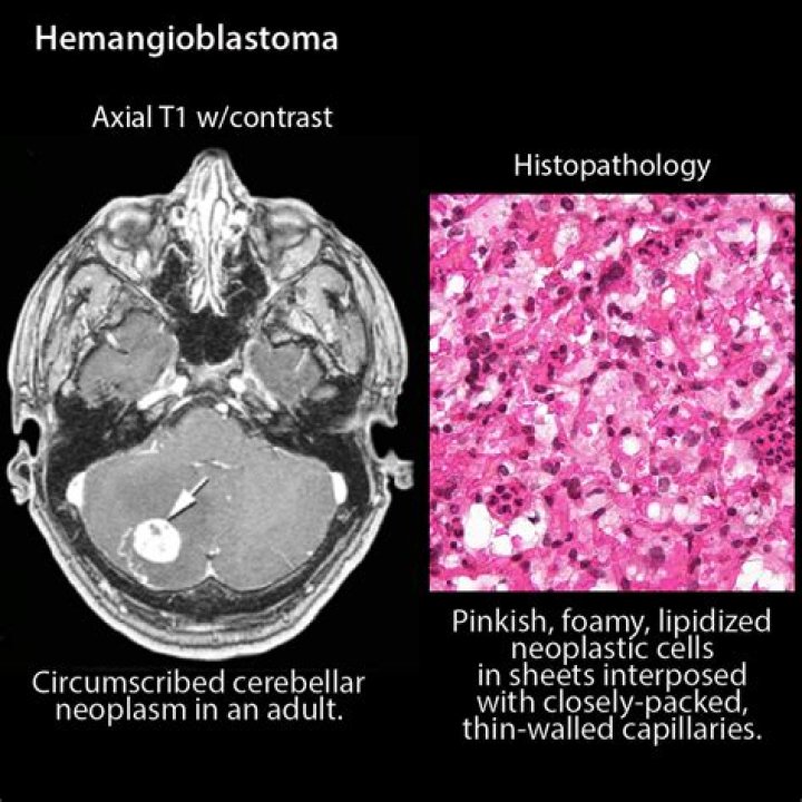 Is Hemangioblastoma a cancer?