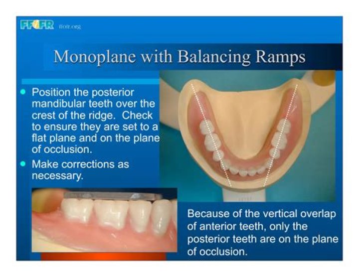 Is monoplane occlusion balanced?
