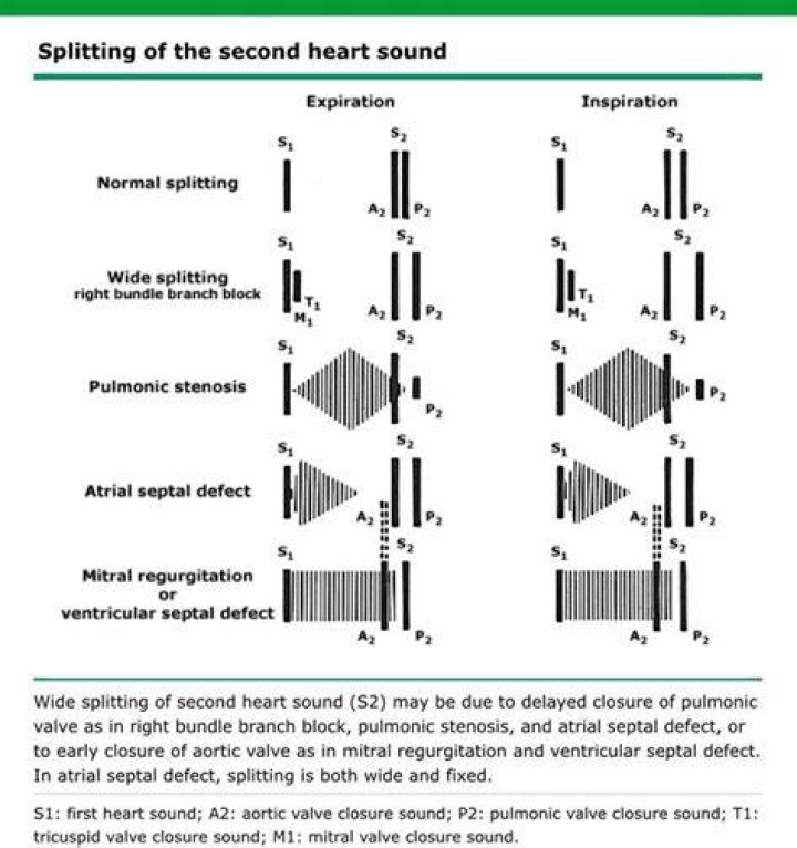Is the second heart sound occasionally split?