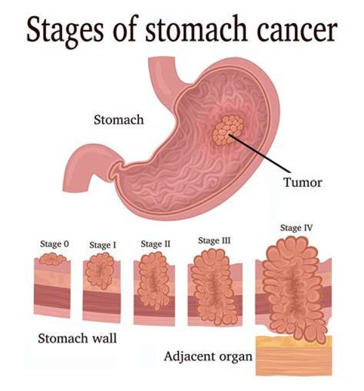 What are the two types of gastric carcinoma?