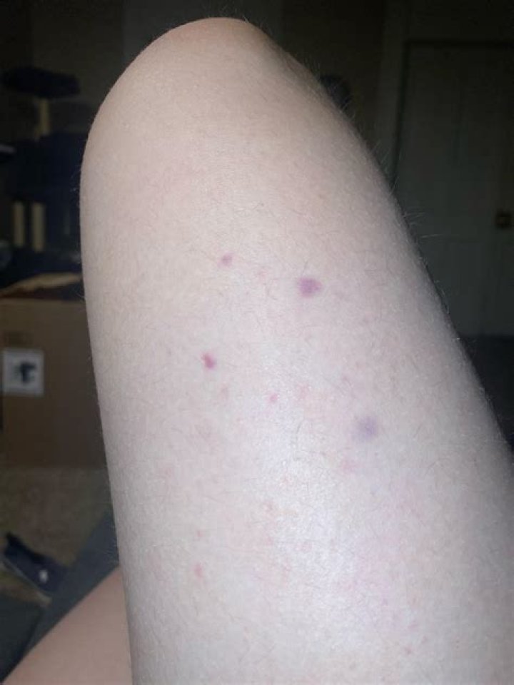 What can cause small bruises to just appear?