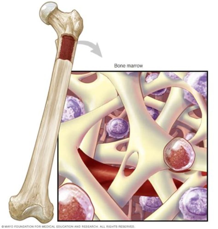 What causes bone marrow aplasia?