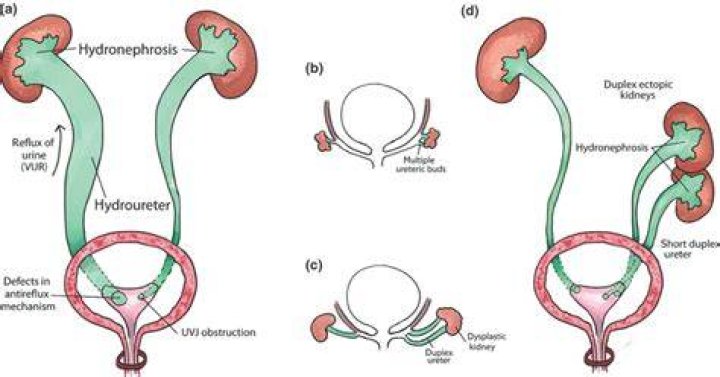 What causes ectopic ureter?