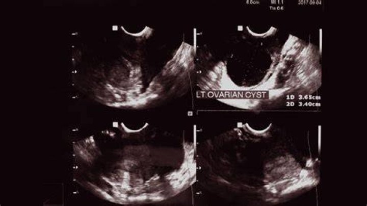 What does a hemorrhagic ovarian cyst look like on ultrasound?