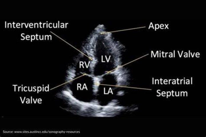 What is a normal echo result?