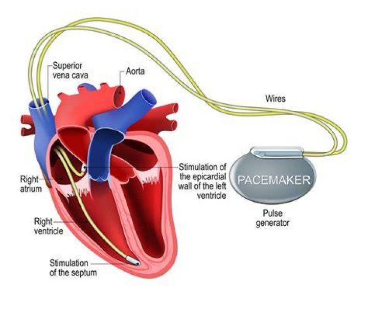What is a pacemaker arrhythmia?