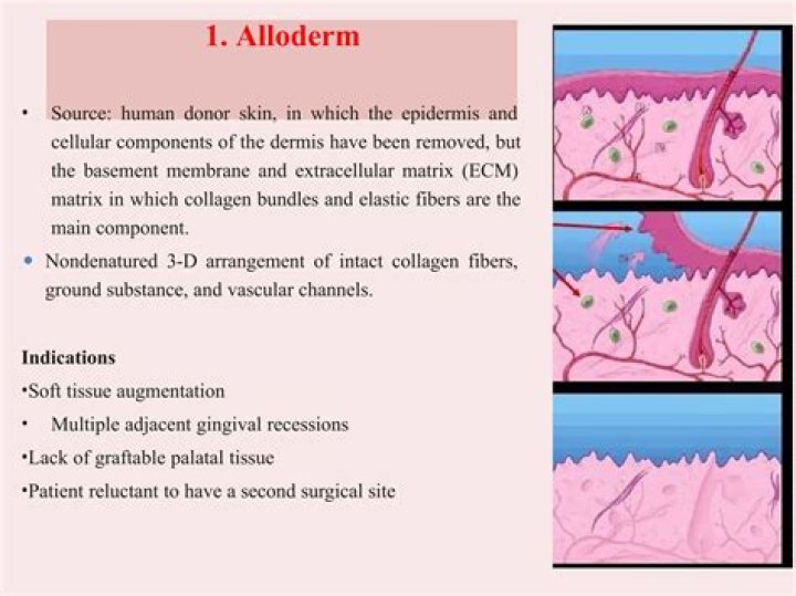 What is AlloDerm reconstruction?
