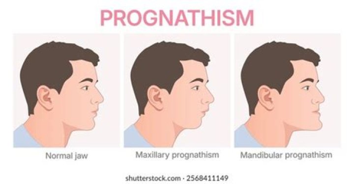 What is facial prognathism?