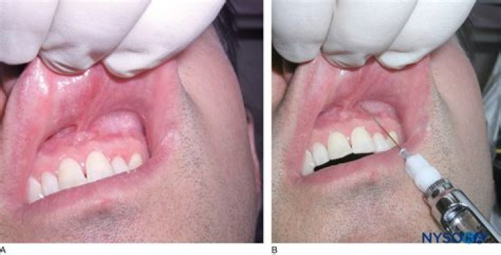 What is infiltrative anesthesia?