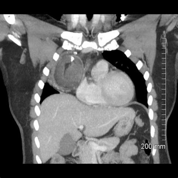What is teratoma in lungs?