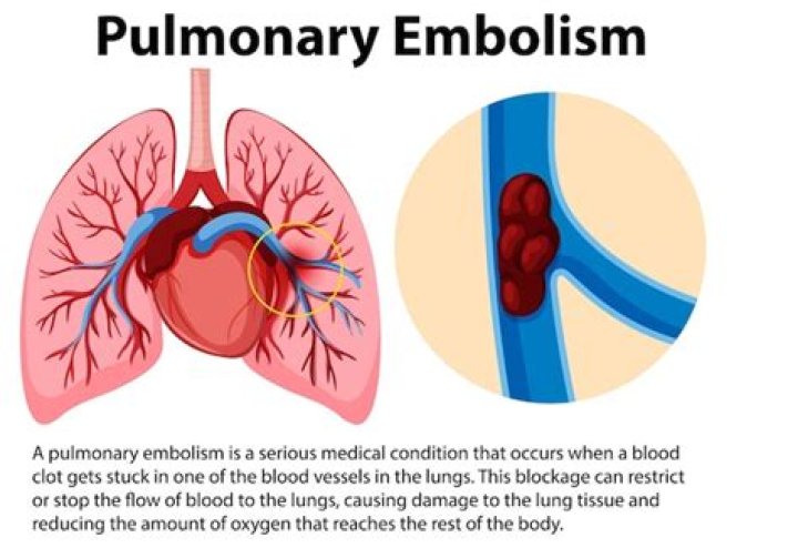 What is the meaning of pulmonary embolism PPT?