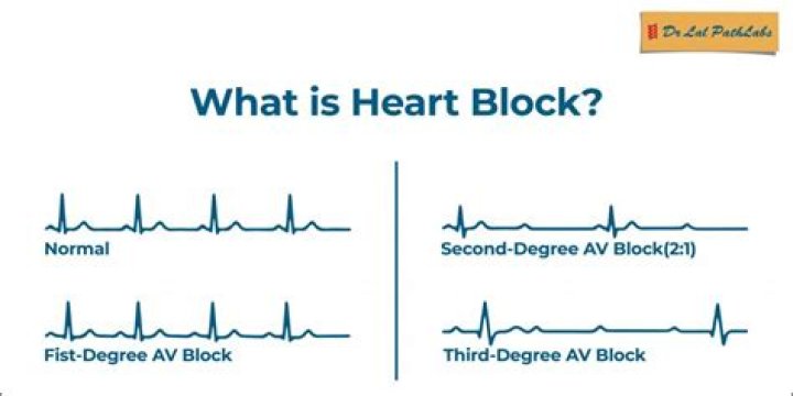 What is the most common cause of complete heart block?