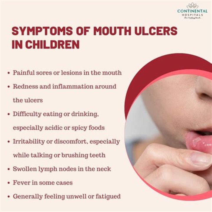What tea is good for mouth ulcers?
