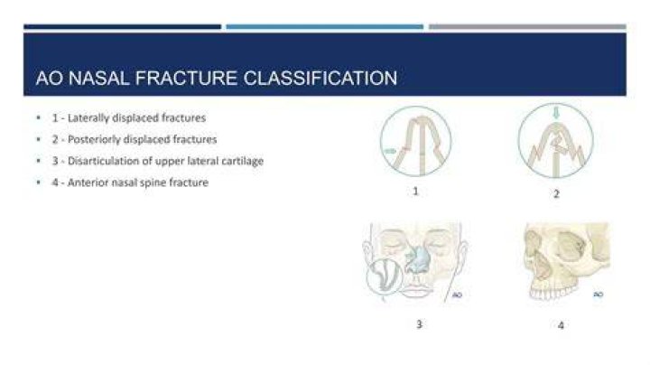 When should a nasal fracture be reduced?