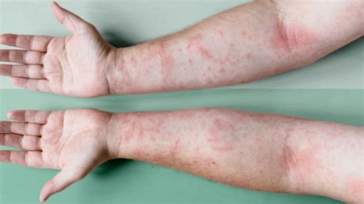 Will allergy testing help eczema?